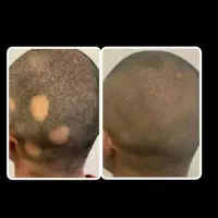 ریزش سکه ای