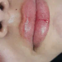 آموزش ژل ،بوتاکس و خاابرداری