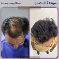 (+فیلم) کلینیک کاشت مو، ابرو و ریش|خدمات آرایشگری و زیبایی|تهران, صادقیه|دیوار