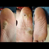 حذف وریشه کن شدن زگیل تناسلی بامحلول گیاهی|خدمات آرایشگری و زیبایی|اصفهان, بوستان ناژوان|دیوار