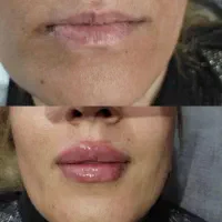 تزریق ژل و بوتاکس مزو تراپی جوانسازی تخلیه میلیا|خدمات آرایشگری و زیبایی|مشهد, ثامن|دیوار