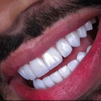 کامپوزیت دندان با چک . اقساط دندانپزشکی . تخفیفات