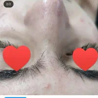 فیشال تخصصی پاکسازی۲۰۰تومان مزو کربوکسی اسیدتراپی|خدمات آرایشگری و زیبایی|مشهد, هدایت|دیوار
