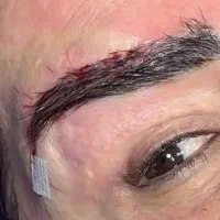 بلفارو غبغب دایرکت پیکر تراشی...توسط پزشک متخصص