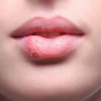 روی سطح پوستت علایم داری