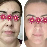 چین وچروک صورت. وبدون بازگشت.|آرایشی، بهداشتی، درمانی|تهران, شوش (باغ آذری)|دیوار