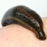 زالو درمانی