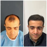 کاشت مو اقساطی