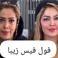 ژل و بوتاکس تخصصی مناسب آقایان و خانم ها