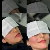 فیلر.ژل.بوتاکس.زاویه سازی.پی ارپی فول فیس|خدمات آرایشگری و زیبایی|مشهد, سناباد|دیوار