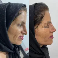 تزریق ژل و بوتاکس و مادلینگ عربی|خدمات آرایشگری و زیبایی|کرمانشاه, |دیوار