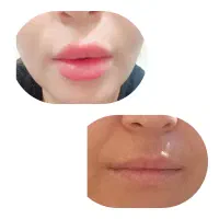 لیزر  فیلر  ژل  بوتاکس پلاژن  فیشیال