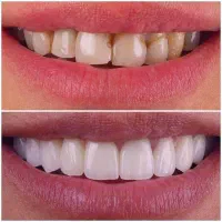 لمینت و کامپوزیت / اقساط 12 ماهه