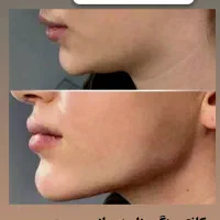 ساکشن شکم پهلو ۱۰ میلیون تومان ، پزشک ۲۰ سال تجربه|خدمات آرایشگری و زیبایی|مشهد, هفت تیر (نه دره)|دیوار