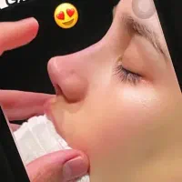 تخفیف عیدانه جراحی بینی