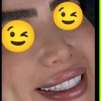 کامپوزیت دندان/دندانپزشکی/ایمپلنت/عصبکشی/ترمیم