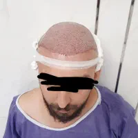 کاشت تخصصی مو و ریش،مزوتراپی،prp(تضمینی)|خدمات آرایشگری و زیبایی|اصفهان, سعادت‌آباد|دیوار