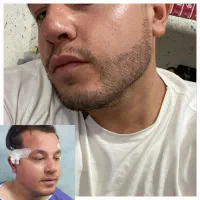 کاشت مو وابرو جشنواره ویژه|خدمات آرایشگری و زیبایی|یزد, |دیوار