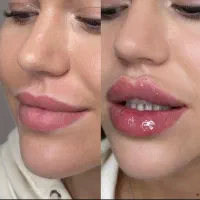 فیلرلب چربی سوز لیزرمو فول فیس لیفت نخ هایفو