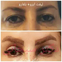 بلفاروپلاستی جراحی پلک لیفت شقیقه ابرو صورت بوتاکس