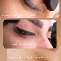 ریموو تک جلسه ای تاتو