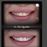 خدمات ویژه کامپوزیت ودندنسازی باقیمت ویژه|خدمات آرایشگری و زیبایی|یاسوج, |دیوار