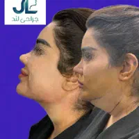 لیپوساکشن غبغب متد وی لاین + بوکال فت + بلفارو