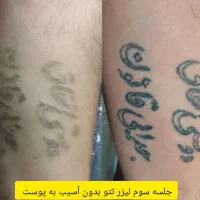 اولین کلینیک تخصصی لیزر تتو