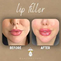 لاغری فیلر بوتاکس نخ جوانساز هایفو پرتو اندام