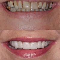 دندانپزشکی/لمینیت/ایمپلنت ( نصف قیمت تعرفه )|خدمات آرایشگری و زیبایی|تهران, فلسطین (میدان انقلاب)|دیوار