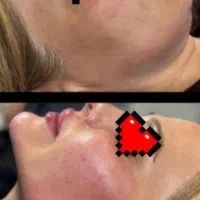 تخفیف تزریق ژل و بوتاکس