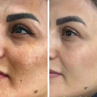 تکنیک تلفیقی پوست شیشه ای