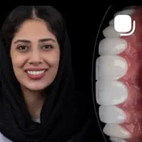 روکش سرامیکی کن لبخند رویایی بزن