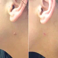 خال برداری رفع کک و مک با لیزر|خدمات آرایشگری و زیبایی|هشتگرد, مدرس|دیوار