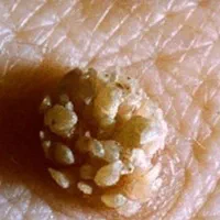 بهبودی کامل زگیل تناسلی hpv