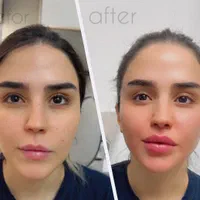 ژل لب کانتورینگ صورت بوتاکس آنزیم فیلر بینی مزوژل
