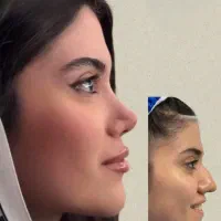 جراحی بینی با تخفیف باورنکردنی 50درصد|خدمات آرایشگری و زیبایی|قرچک, شهرک طلائیه|دیوار