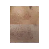 لک جوش و منافذ و جای جوش و لیفت و جوانسازی صورت|خدمات آرایشگری و زیبایی|زاهدان, |دیوار