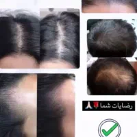 قطع کامل ریزش موباضمانت.تونیک گیاهی هیرفرند|آرایشی، بهداشتی، درمانی|اصفهان, شهرک ولیعصر|دیوار