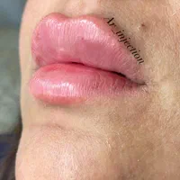 آموزش و تزریق ژل و بوتاکس|خدمات آرایشگری و زیبایی|مسجد سلیمان, |دیوار