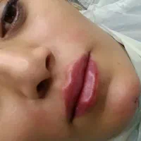 میکروبلیدینگ فیلرو بوتاکس شیدینگ تخفیف یلدایی|خدمات آرایشگری و زیبایی|بیرجند, |دیوار