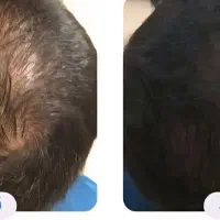 مزوتراپی و پی آر پی مو و ابرو|خدمات آرایشگری و زیبایی|اردبیل, |دیوار