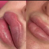 آموزش ژل و بوتاکس