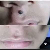 برداشت انواع خال وزگیل با مواد کاملا گیاهی