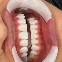 کامپوزیت دندان|خدمات آرایشگری و زیبایی|بوشهر, |دیوار