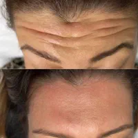 اموزش. بوتاکس فول فیس چشم گربه ای لیفت شقیقه