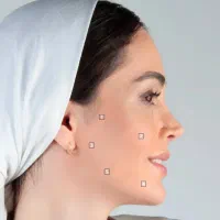 انجام خدمات مزونیدلینگ،جوانسازی ، ژل و بوتاکس