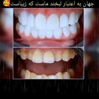 مژده مژده کامپوزیت برای یک ماه تخفیف ویژه