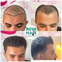 جشنواره تخفیف کاشت مو و ابرو بیمارستان MRI شیراز