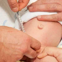 ختنه به روش جراحی با بخیه زیبایی